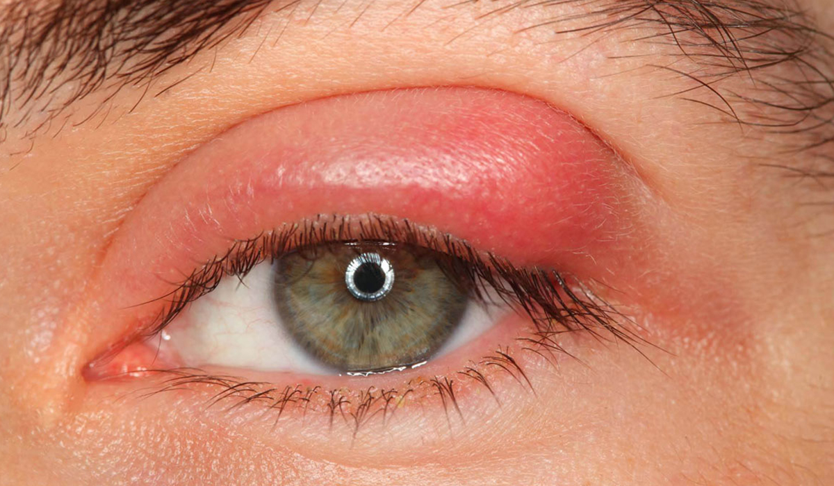 Causes of eye swelling and treatment with natural methods |  Dr. Ahdi Ghanima's blog